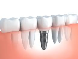 What is dental implant