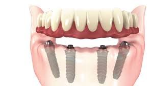 All of 4 Implants