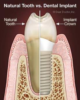 dental implant
