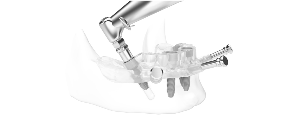 dental implant
