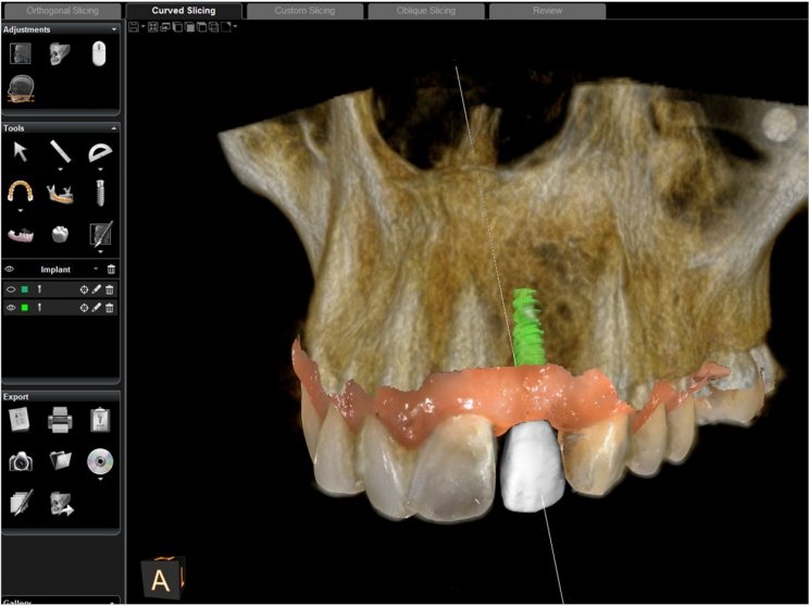 dental implant