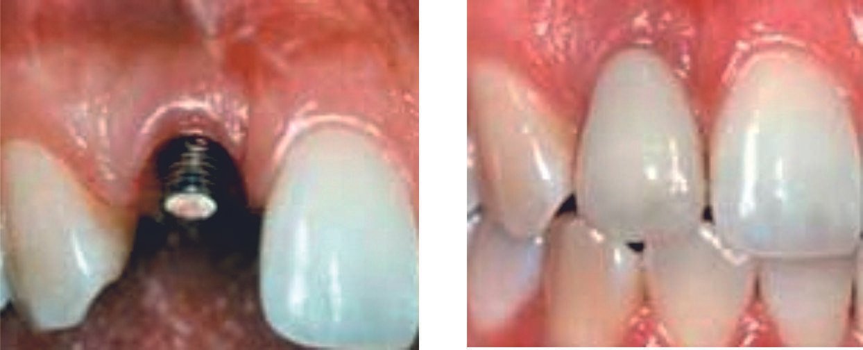 dental implants