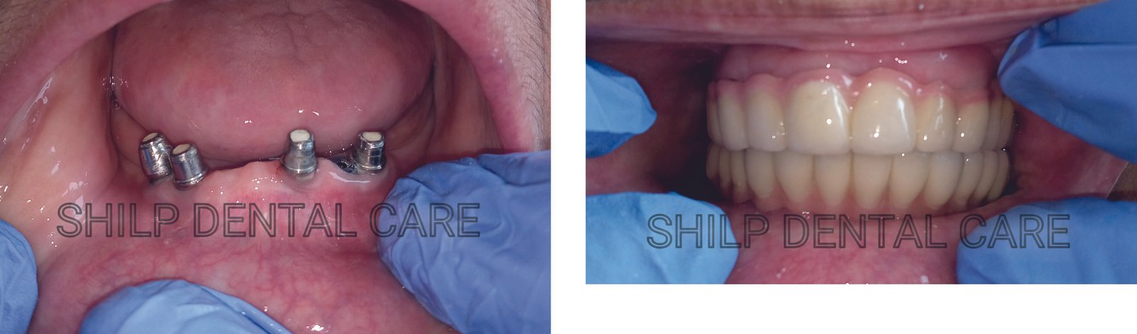 dental implants