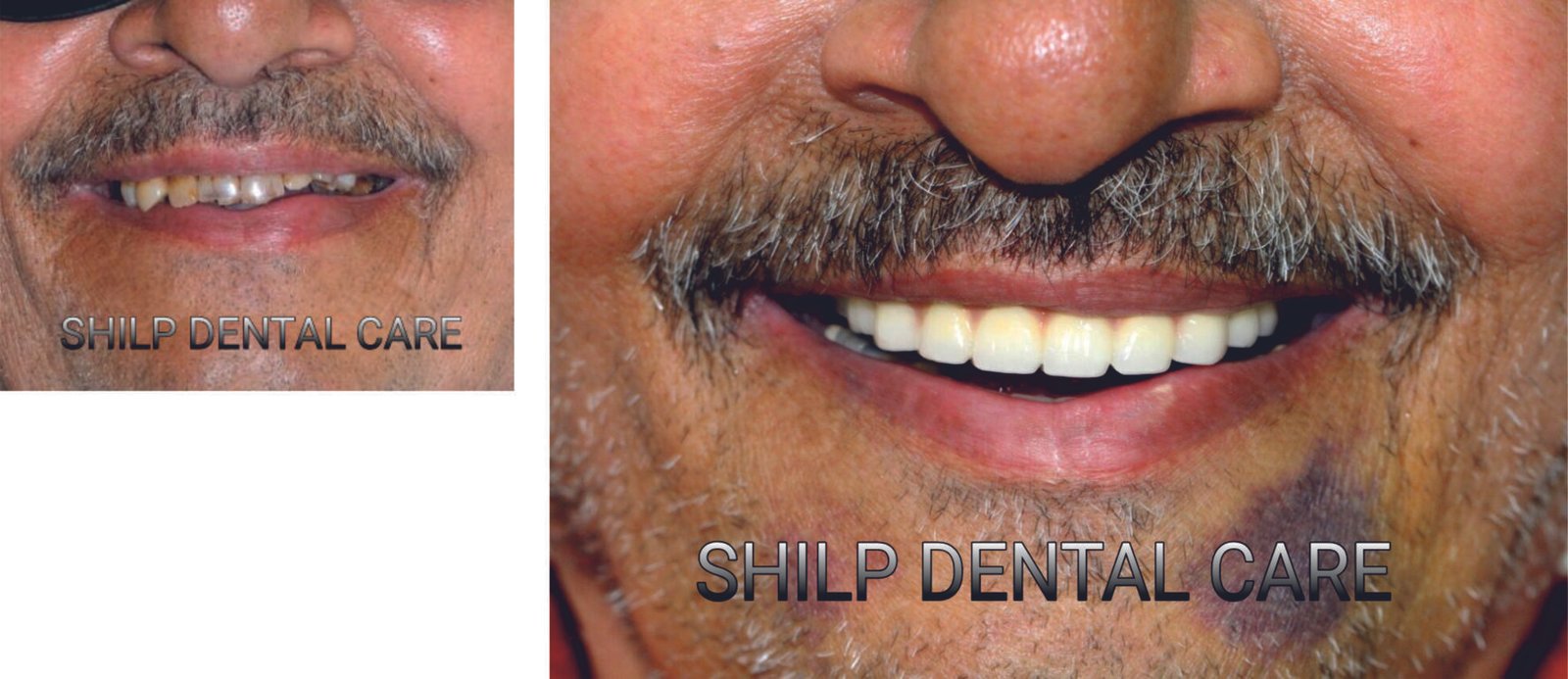 dental implants