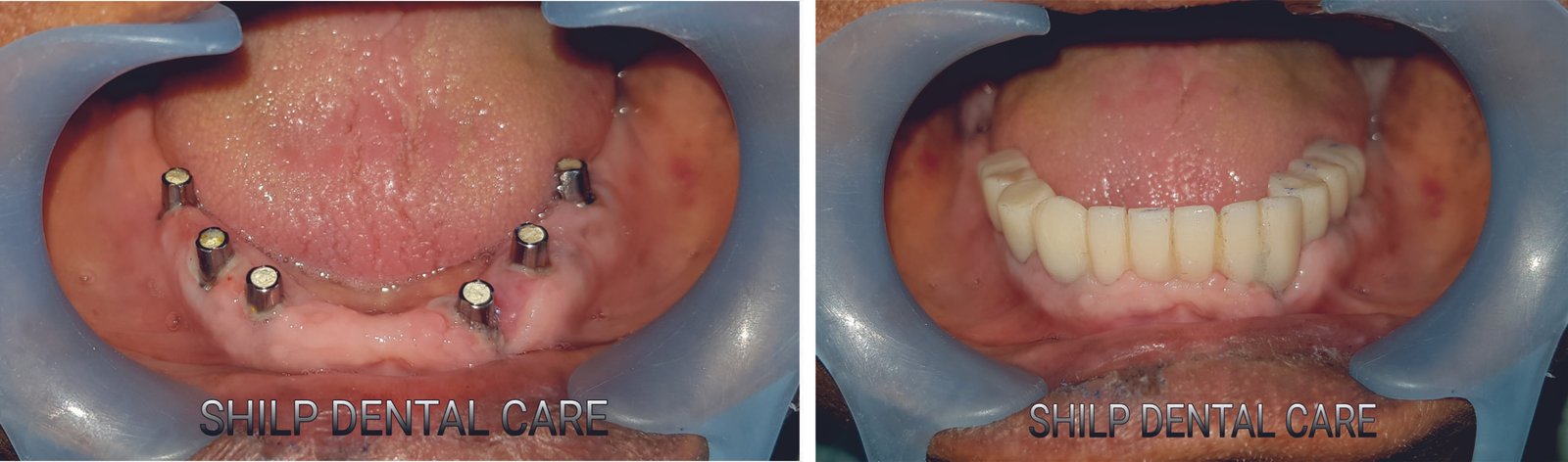 dental implants