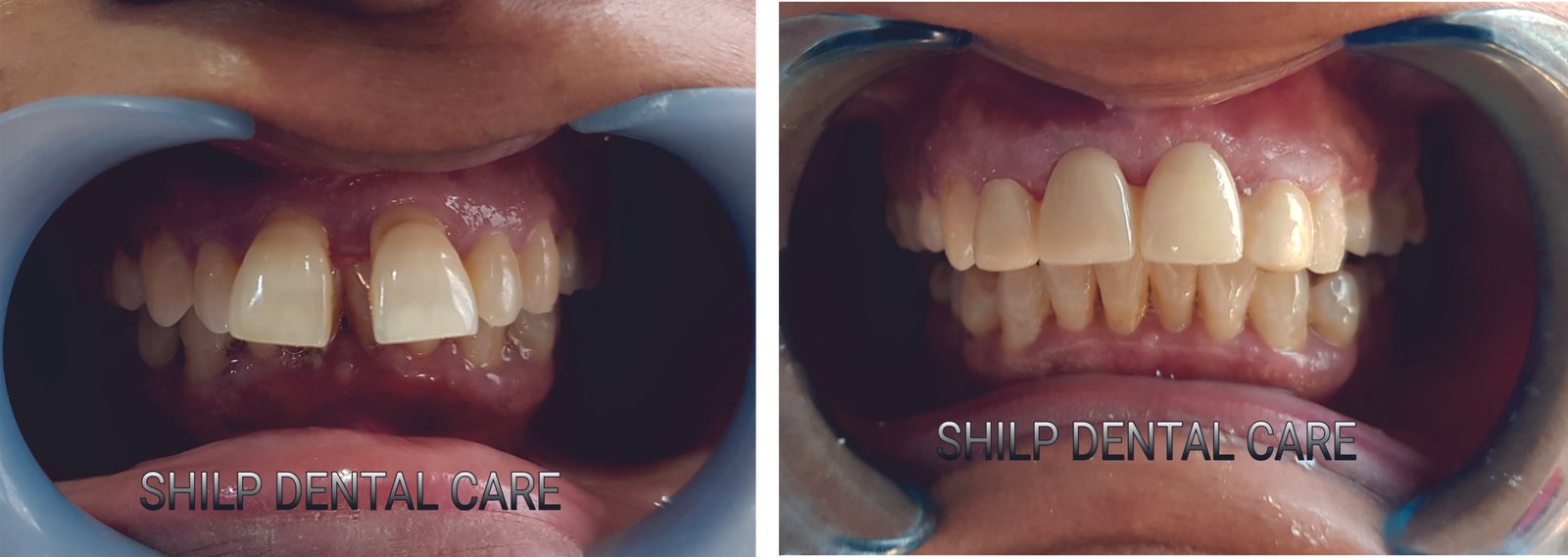 dental implants