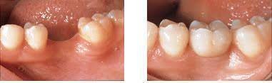 dental implants