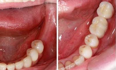dental implants