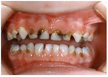 paediatric dentist in ahmedabad