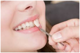 cosmetic-dentistry-in-ahmedabad