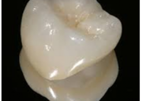 Dental Crown Ahmedabad