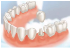 Dental Crown bridges 
