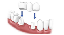 Dental Crown bridges 