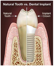 best implant dentist in Ahmedabad