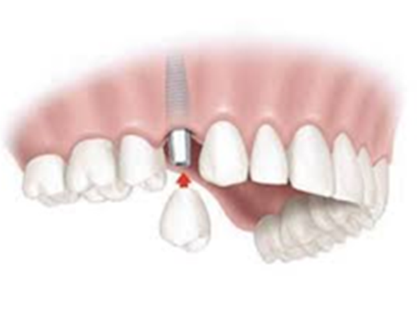  Single tooth replacement dental implant