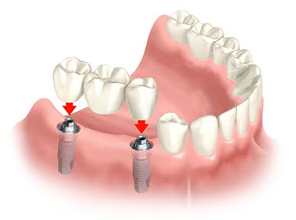 Multiple teeth replacement dental implant