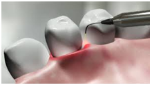 Laser Dentistry