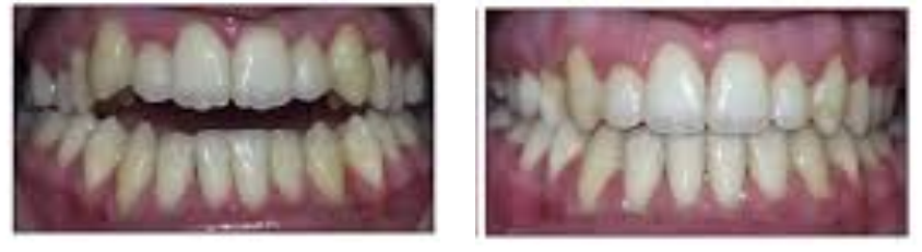 orthodontist treatments Before 