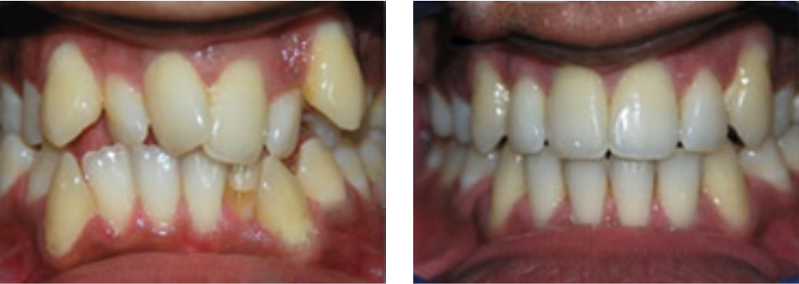  After orthodontist treatment