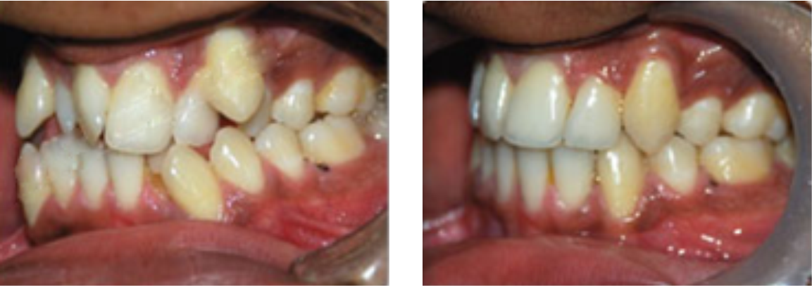 orthodontic-treatment Before and After