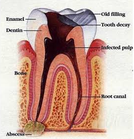 Root Canal Ahmedabad