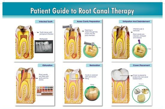 Root Canal