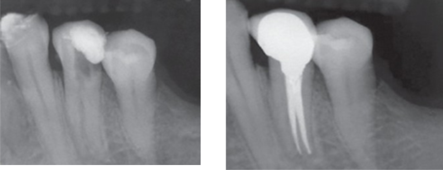 Root Canal Before