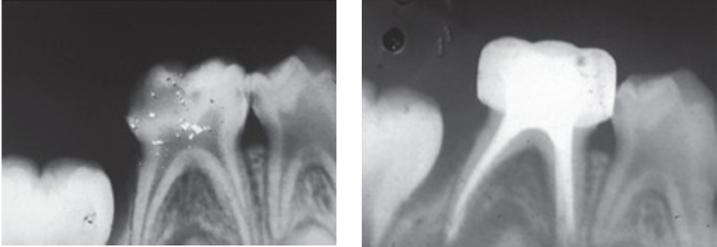 Root Canal After 