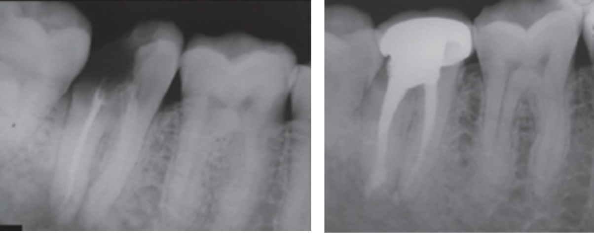 Root Canal Before and after1