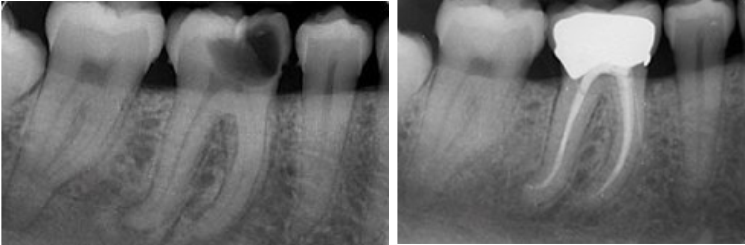Root Canal Before and after2