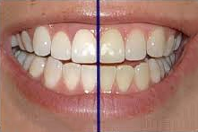 teeth whitening ahmedabad