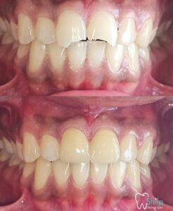 Upper anterior