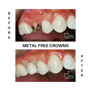 crown