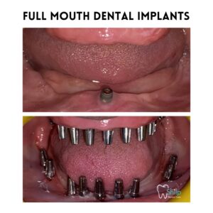 full mouth implant (2)