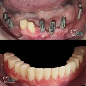 lower arch implants