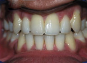 orthodontic-treatment-post4