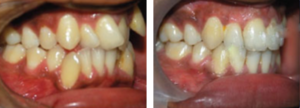 orthodontic-treatment-pre3
