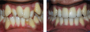 orthodontic-treatment-pre4