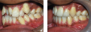 orthodontic-treatment-pre5