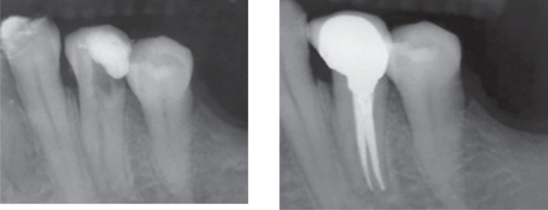 root-canal3