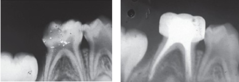 root-canal5
