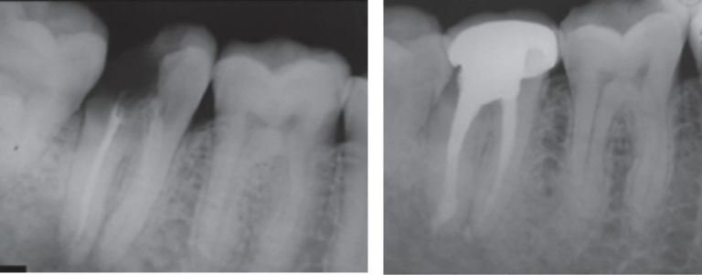 root-canal7
