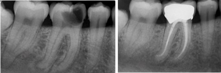 root-canal9