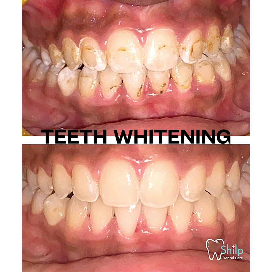 teeth whitening (2)