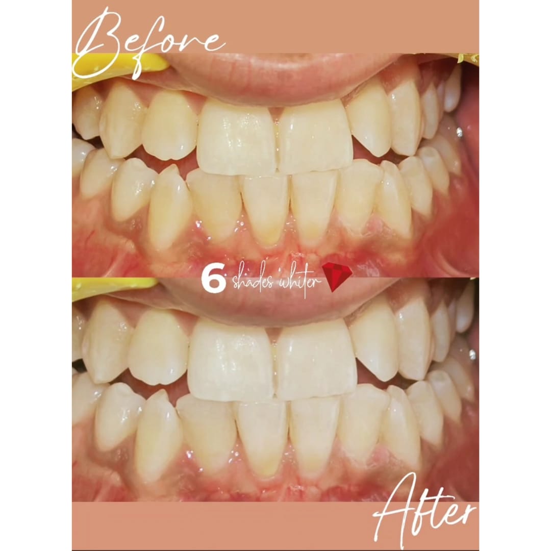 teeth whitening