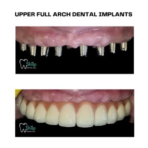 upper arch implant