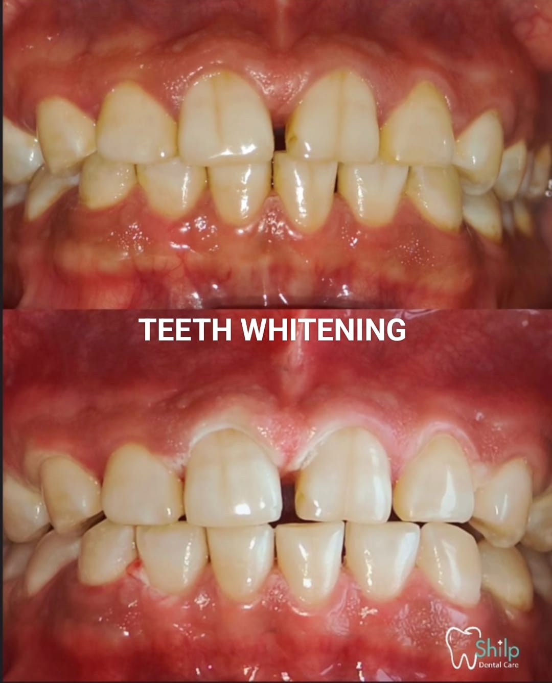 whitening